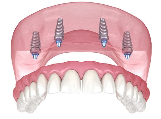 Illustration of an implant denture