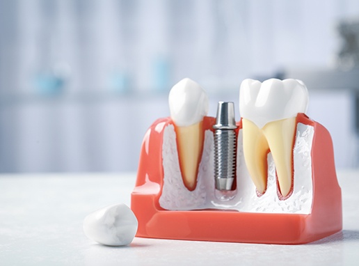a model showing a dental implant and abutment