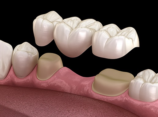 Animated smile during dental bridge placement