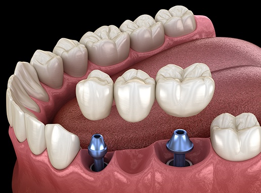 Animated smile during dental implant supported dental bridge placement