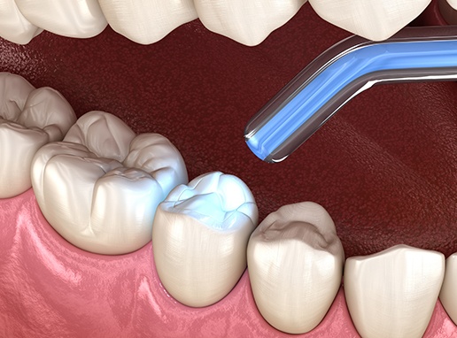 Animated smile during cosmetic dental bonding