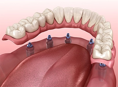 Animated dental implant denture placement