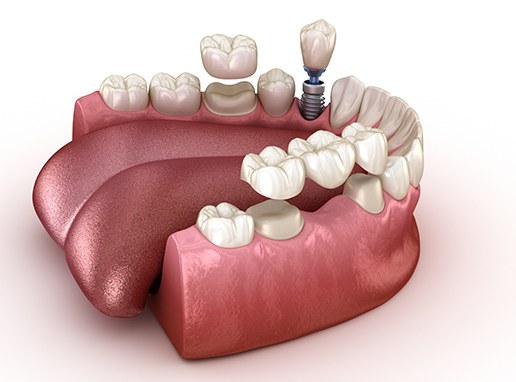 Animated smile during full mouth reconstruction