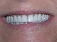 Gorgeous smile after top front two teeth are repaired with porcelain dental crowns