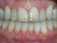 Smile with damaged top front tooth