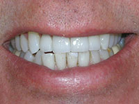 Smile enhanced with porcelain veneers