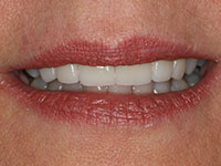 Discolored teeth enhanced with porcelain dental crowns