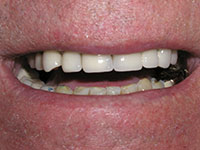 Smiled restored with porcelain dental crowns