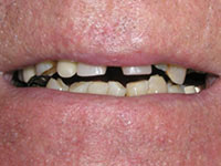 Damaged and unevenly spaced teeth
