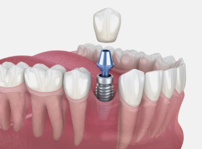 Animated dental implant supported dental crown placement