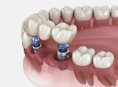 Animated dental implant supported fixed bridge placement