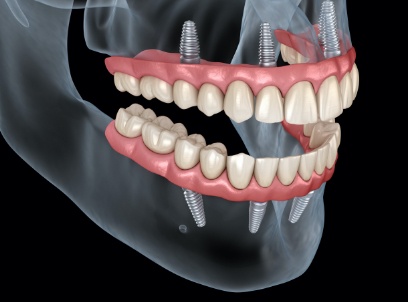 Animated dental implant supported denture placement