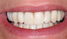 Closeup of healthy bright smile after dental treatment