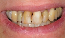 Closeup of yellowed decayed teeth before dental treatment