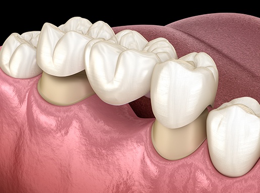 Animated smile during dental bridge treatment