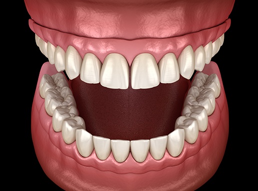 Animated smile after dentures treatment