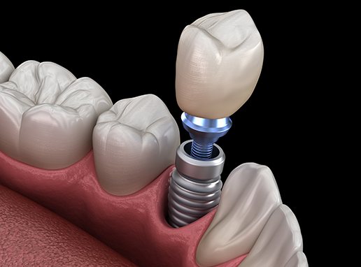 Animated smile during dental implant tooth replacement