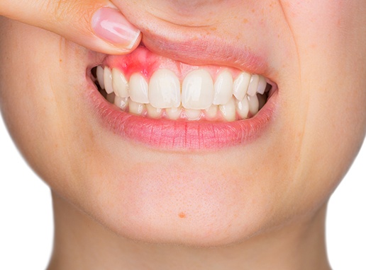 Closeup of smile with red inflamed gum tissue