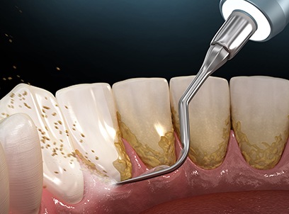 Animated smile during scaling and root planing treatment