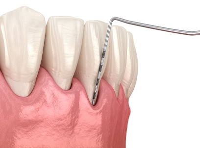 Animated smile during topical antibiotic treatment