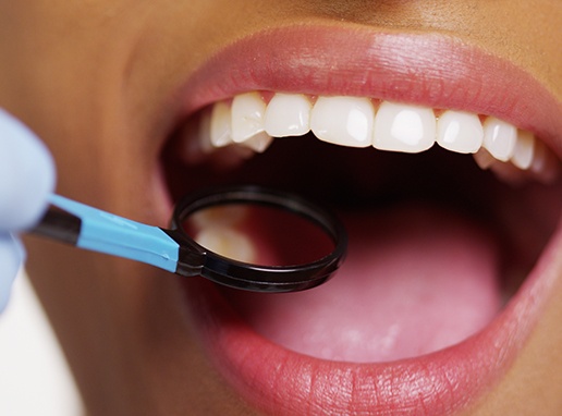 Dentist examining patient's smile after dental sealant placement