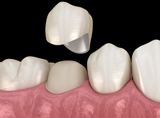 Aniamted smile during dental crown placement