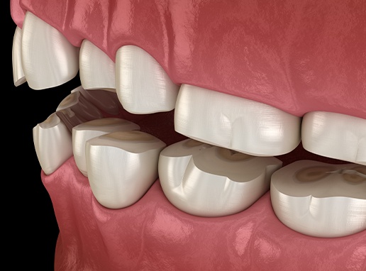 Animated smile with severely worn teeth before full mouth reconstruction