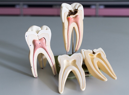Model of the inside of a healthy tooth and damaged tooth in need of root canal