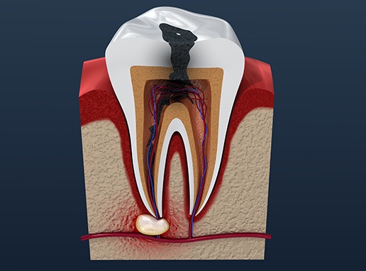 Animated tooth with decay in need of root canal therapy