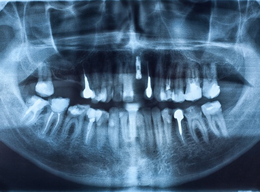 Panorex digital x-rays