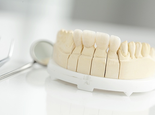Wax up model of smile with fixed bridge restoration