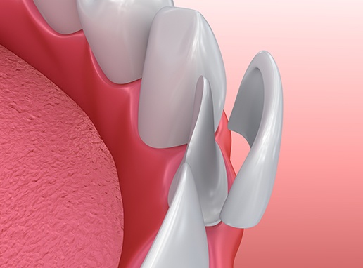 Animated smile during porcelain veneer placement