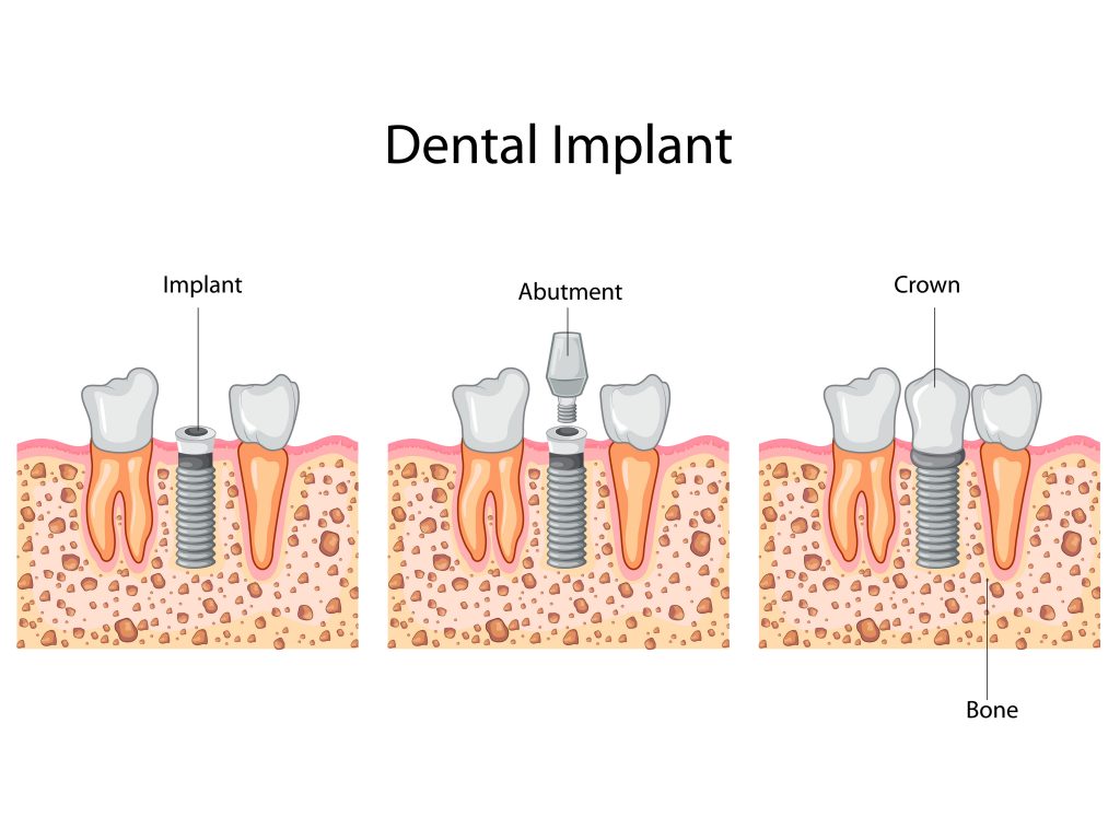 illustration of dental implant