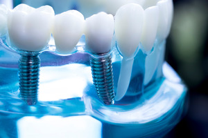 Dental implants in plastic model alongside fake teeth
